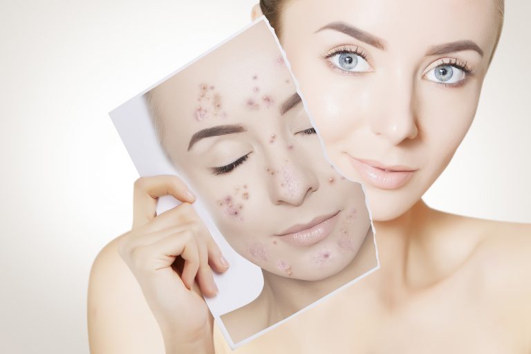 Acne Treatment Dermatology Services ForCare Medical Center Medical Practice Clinical Research Tampa, FL