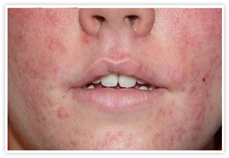 Acne Vulgaris Medical Conditions researched ForCare Medical Center Clinical Trials