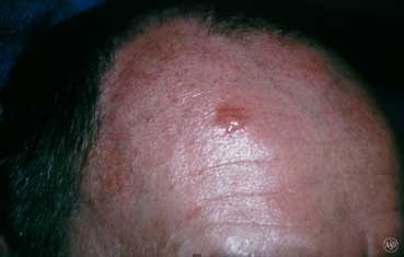 Skin Cancer Medical Conditions researched ForCare Medical Center Clinical Trials