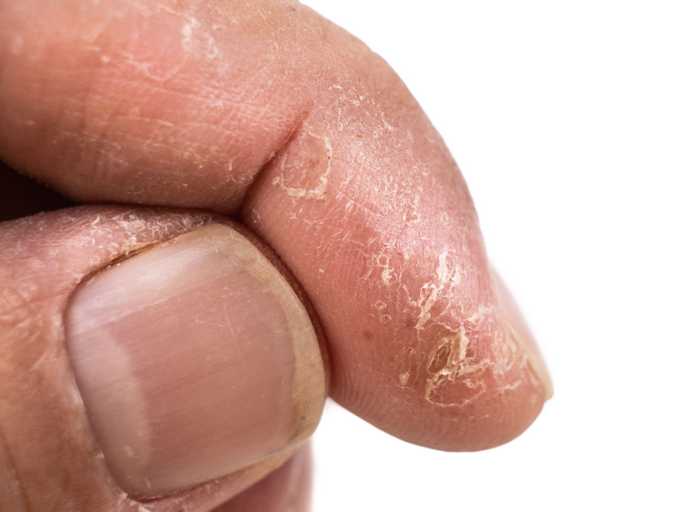 Four nail disorders every clinician should know  Clinical Advisor